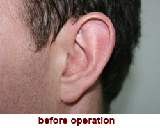 plastic-surgery-prominent-ear 